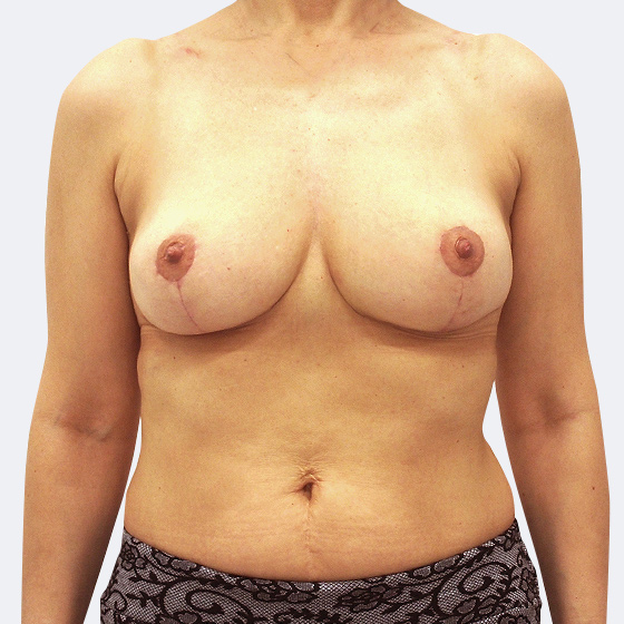 Klientka před a po zmenšení poprsí s modelací. Odebráno bylo z levého prsu 146 gramů a z pravého prsu 149 gramů kůže a měkkých tkání. Foceno měsíc po zákroku.