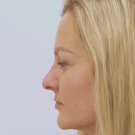Klientka před a po plastické operaci nosu, foceno měsíc po zákroku.
Operatér: MUDr. Peter Ondrejka