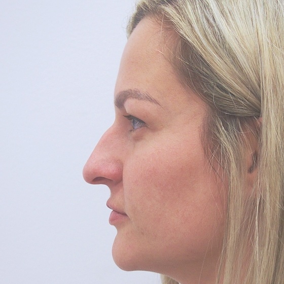 Klientka před a po plastické operaci nosu, foceno měsíc po zákroku.
Operatér: MUDr. Peter Ondrejka