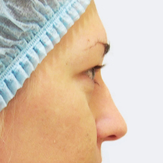 Klientka před a po plastické operaci horních i dolních víček v lokální anestezii, foceno 3 měsíce po zákroku.
Operatér: MUDr. Michal Puls, CSc.