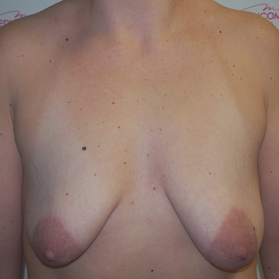 Klientka před a po zvětšení prsou s modelací. Použity byly kulaté implantáty o velikosti 300 mililitrů. 
Operatér: Prim. MUDr. Petr Pachman