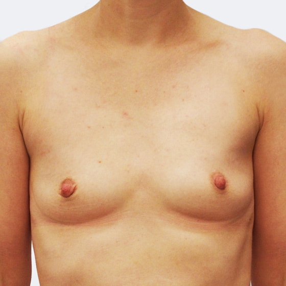 Klientka před a po zvětšení prsou. Použity byly kapkovité implantáty o velikosti 350 mililitrů. Vloženy byly podprsní rýhou pod sval.
Operatér: MUDr. Pavel Popelka