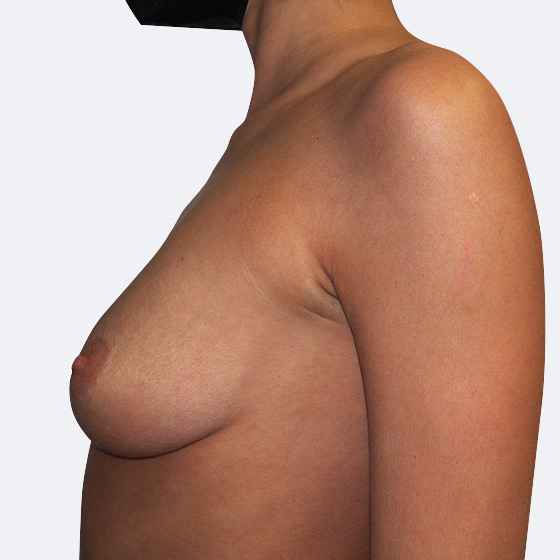 Klientka před a po zvětšení prsou. Použity byly kulaté implantáty o velikosti 375 mililitrů, vysoký profil. Vloženy byly podprsní rýhou pod sval.
Operatér: Prim. MUDr. Petr Pachman