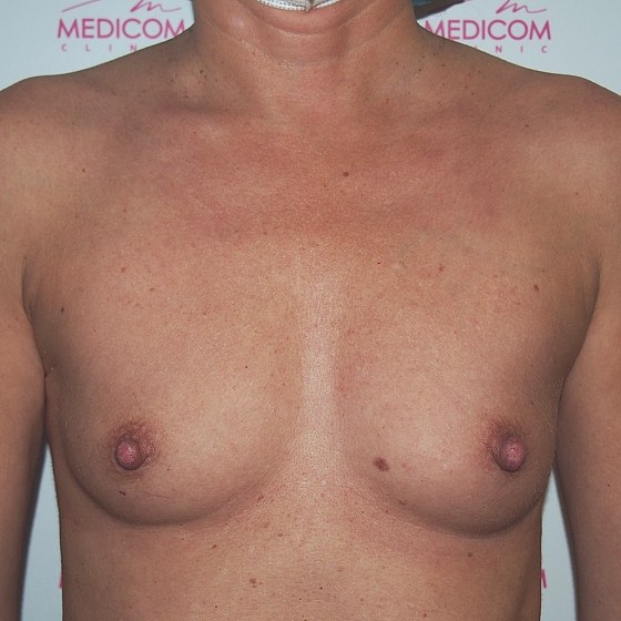 Klientka před a po zvětšení prsou. Použity byly kulaté implantáty o velikosti 275 mililitrů. Vloženy byly podprsní rýhou pod sval.
Operatér: Prim. MUDr. Petr Pachman