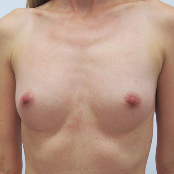Klientka před a po zvětšení prsou. Použity byly kulaté implantáty o velikosti 320ml., střední profil.
Operatér: MUDr. Petros Christodoulou