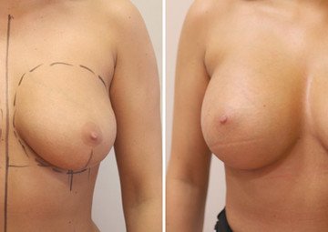 Průběh operace - Paní Dana - plastická operace prsou