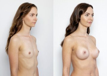 Průběh operace - Paní Michaela - augmentace prsou
