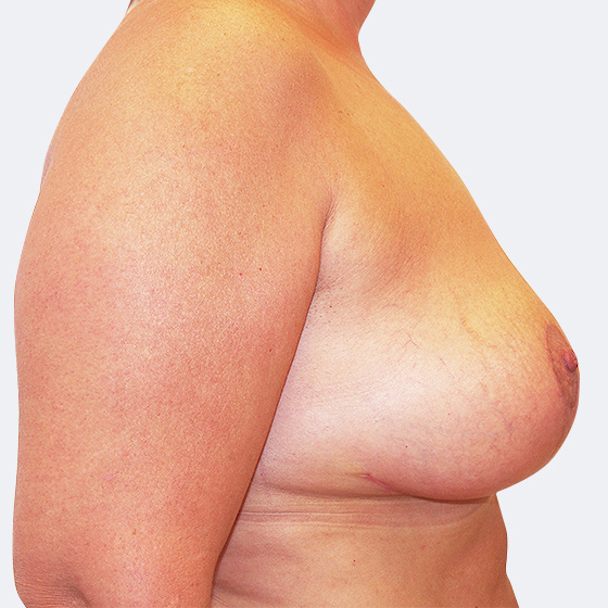 Klientka před a po modelaci prsou středního rozsahu (při poklesu poprsí), foceno měsíc po zákroku.
Operatér: Prim. MUDr. Petr Pachman 