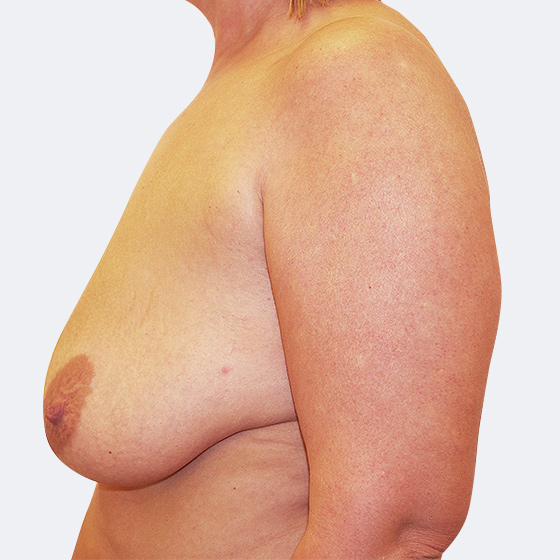 Klientka před a po modelaci prsou středního rozsahu (při poklesu poprsí), foceno měsíc po zákroku.
Operatér: Prim. MUDr. Petr Pachman 