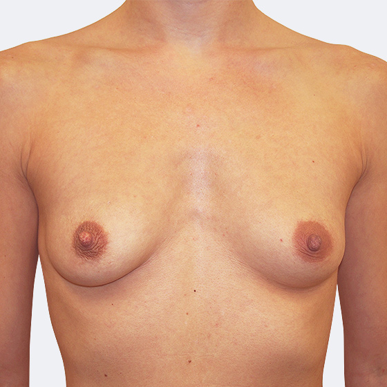 Klientka před a po zvětšení prsou. Použity byly anatomické implantáty o velikosti 330 mililitrů. Vloženy byly podprsní rýhou pod sval.
