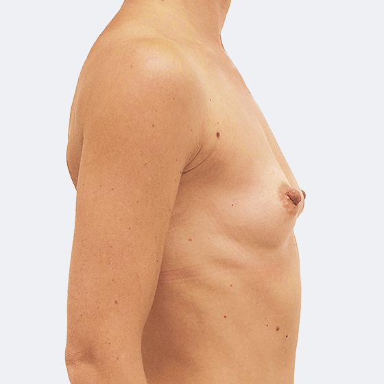 Klientka před a po zvětšení prsou. Použity byly kapkovité implantáty o velikosti 315ml, vysoký profil. Vloženy byly podprsní rýhou pod sval.