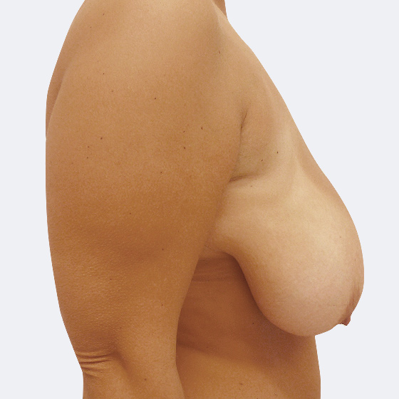 Klientka (40 let) před a po modelaci prsou středního rozsahu (při poklesu poprsí), foceno 6 týdnů po zákroku.
Operatér: Prim. MUDr. Pavel Horyna
 
