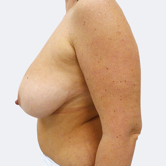 Klientka před a po zmenšení poprsí s modelací. Odebráno bylo z levého prsu 340 gramů a z pravého prsu 260 gramů kůže a měkkých tkání. Foceno 4 měsíce po zákroku.