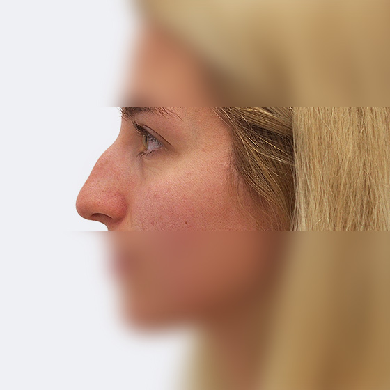 Klientka před a po plastické operaci nosu, foceno měsíc po zákroku.