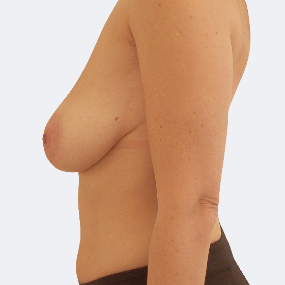 Klientka (43 let) před a po modelaci prsou středního rozsahu (při poklesu poprsí), foceno 2 měsíce po zákroku.
Operatér: Prim. MUDr. Pavel Horyna