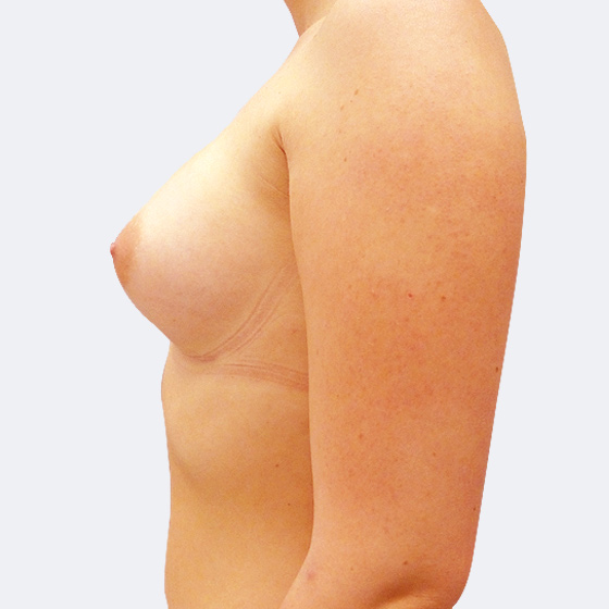 Klientka před a po zvětšení prsou. Použity byly kulaté implantáty o velikosti 275 mililitrů, vysoký profil. Vloženy byly podprsní rýhou pod sval. Foceno 4 měsíce po zákroku.