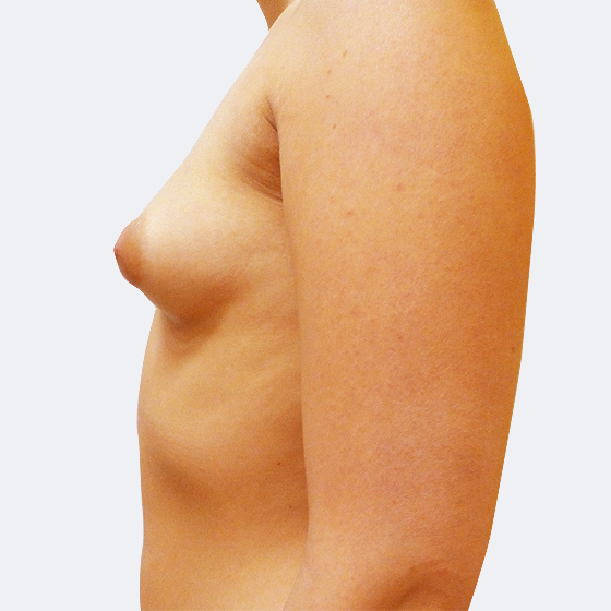 Klientka před a po zvětšení prsou. Použity byly kulaté implantáty o velikosti 275 mililitrů, vysoký profil. Vloženy byly podprsní rýhou pod sval. Foceno 4 měsíce po zákroku.