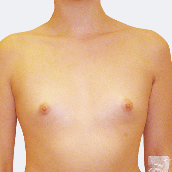 Klientka před a po zvětšení prsou. Použity byly kulaté implantáty o velikosti 500 mililitrů, vysoký profil. Vloženy byly podprsní rýhou pod sval.