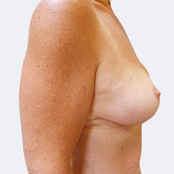 Klientka před a po zmenšení poprsí s modelací. Odebráno z každého prsa 460 gramů kůže a měkkých tkání. Foceno čtyři měsíce po operaci.