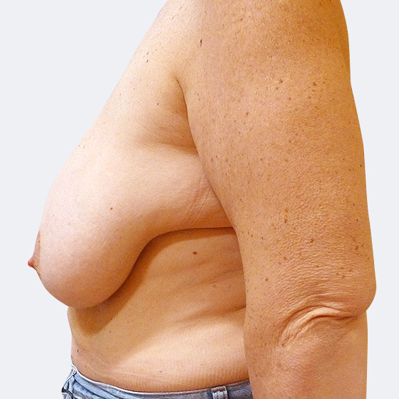 Klientka před a po zmenšení poprsí s modelací. Odebráno z každého prsa 460 gramů kůže a měkkých tkání. Foceno čtyři měsíce po operaci.