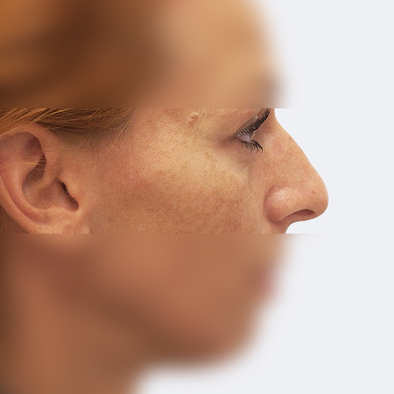 Klientka před a po plastické operaci nosu, foceno 3 měsíce po zákroku.