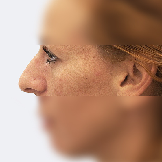 Klientka před a po plastické operaci nosu, foceno 3 měsíce po zákroku.