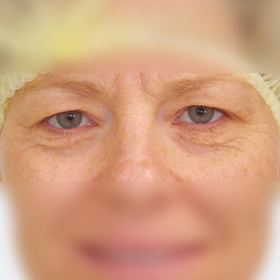 Klientka před a po operaci horních očních víček, 41 let. Foceno 3 měsíce po zákroku.
Operatér: Prim. MUDr. Petr Pachman