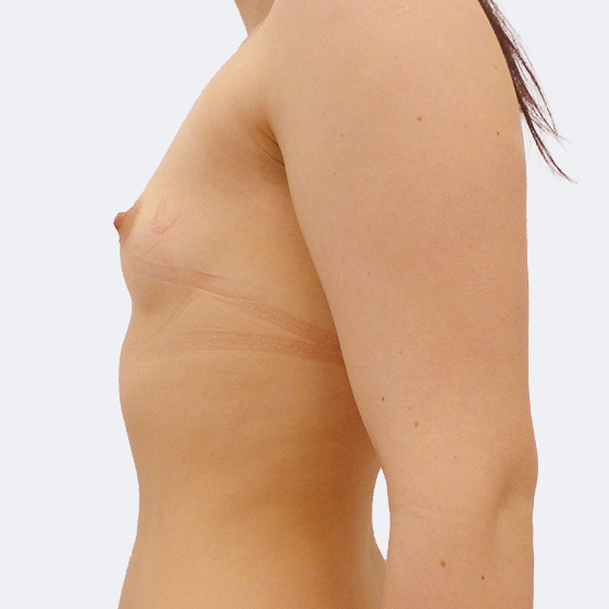 Klientka před a po zvětšení prsou. Použity byly kulaté implantáty o velikosti 350 mililitrů. Vloženy byly podprsní rýhou pod sval.