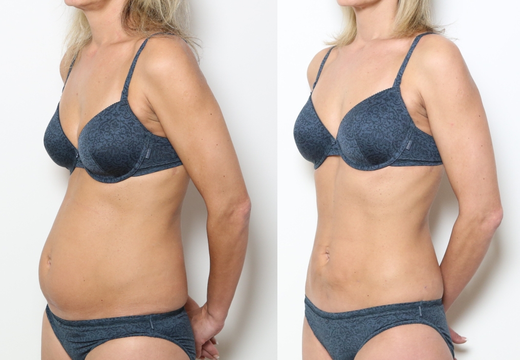 tummy tuck before and after, tummy tuck cost, liposuction, 360 lipo, vaser lipo