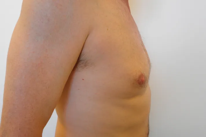 gynekomastie1 po&nbsp;FRANCU