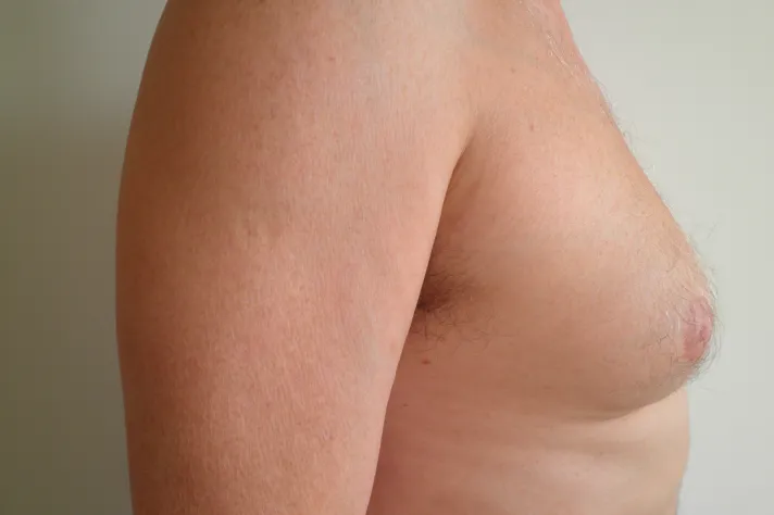 Gynekomastie1 před&nbsp;FRANCU