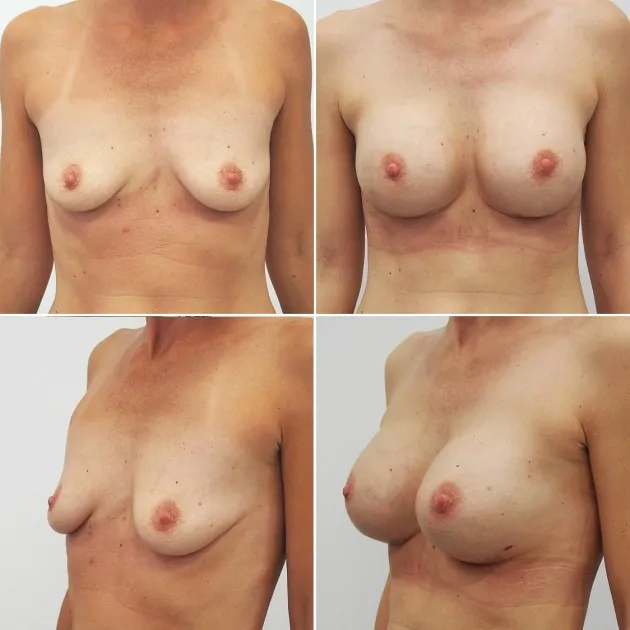/media/upload/articles/Augmentace implantáty vč.jpg /media/upload/articles/Augmentace implantáty vč.jpg