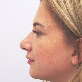 /media/upload/articles/rhinoplastikapo.jpeg /media/upload/articles/rhinoplastikapo.jpeg