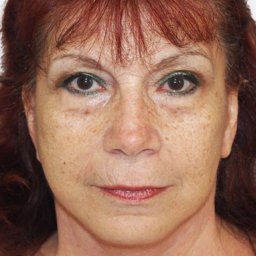 Image after