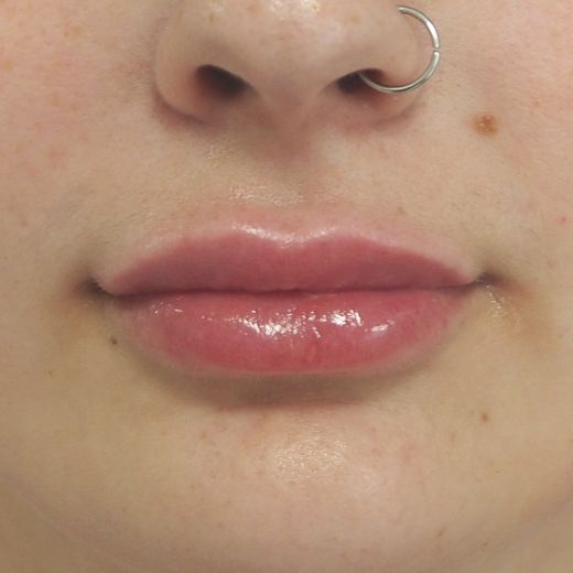 Image after