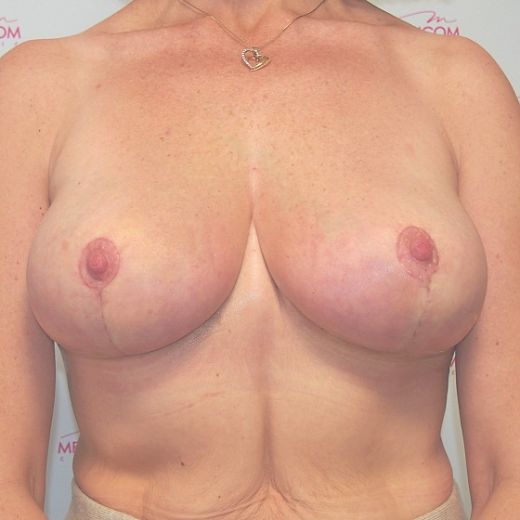 Image after