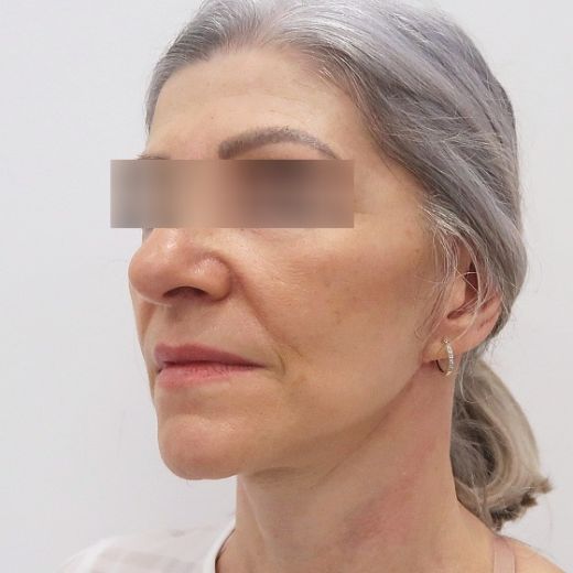 Image after