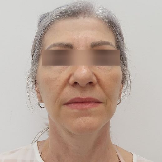 Image after