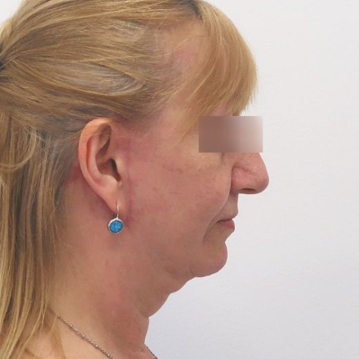 Image after