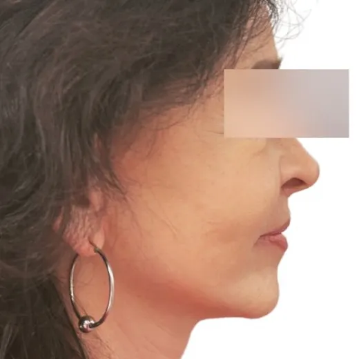 Image after