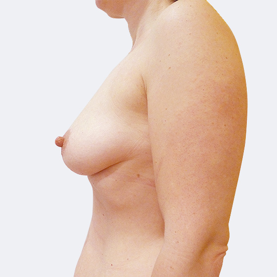 Klientka před a po zákroku zvětšení prsou s modelací. Použity byly kulaté implantáty o velikosti 195 mililitrů, střední profil. Foceno 2 měsíce po operaci.