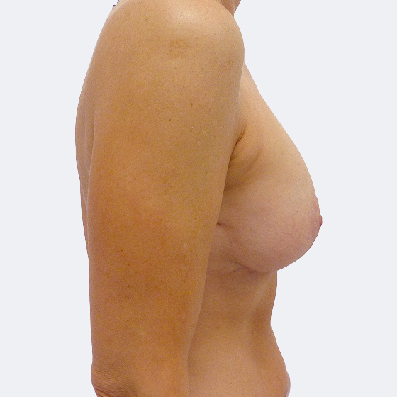 Klientka před a po zákroku zvětšení prsou s modelací. Použity byly kulaté implantáty o velikosti 220 mililitrů, střední profil. Foceno 2 měsíce po operaci.