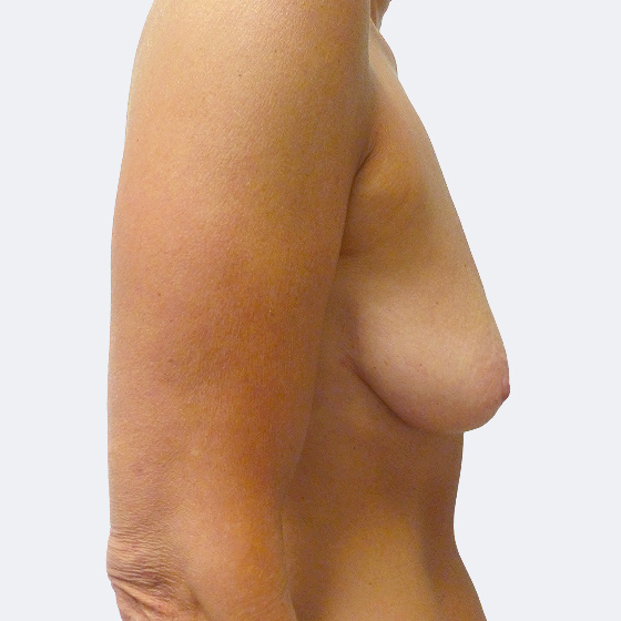 Klientka před a po zákroku zvětšení prsou s modelací. Použity byly kulaté implantáty o velikosti 220 mililitrů, střední profil. Foceno 2 měsíce po operaci.
