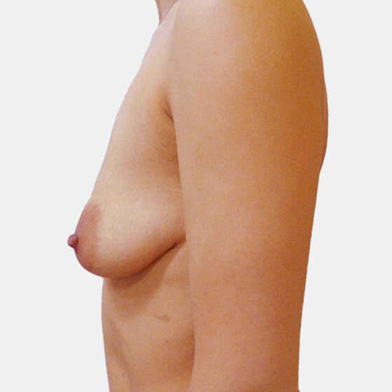 Klientka před a po zákroku zvětšení prsou s modelací. Použity byly kulaté implantáty o velikosti 360 mililitrů, vysoký profil. Foceno 3 měsíce po operaci.