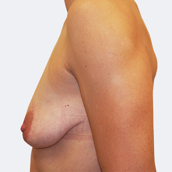 Klientka před a po zvětšení prsou s modelací. Použity byly anatomické implantáty o velikosti 375 mililitrů. Vloženy byly podprsní rýhou pod sval.
Operatér: Prim. MUDr. Petr Pachman