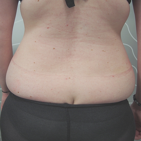 Klientka před a po neinvazivní liposukci (kryolipolýza) v oblasti břicha a boků. Klientka absolvovala 2 ošetření (úbytek 6cm tukové vrstvy v pase)