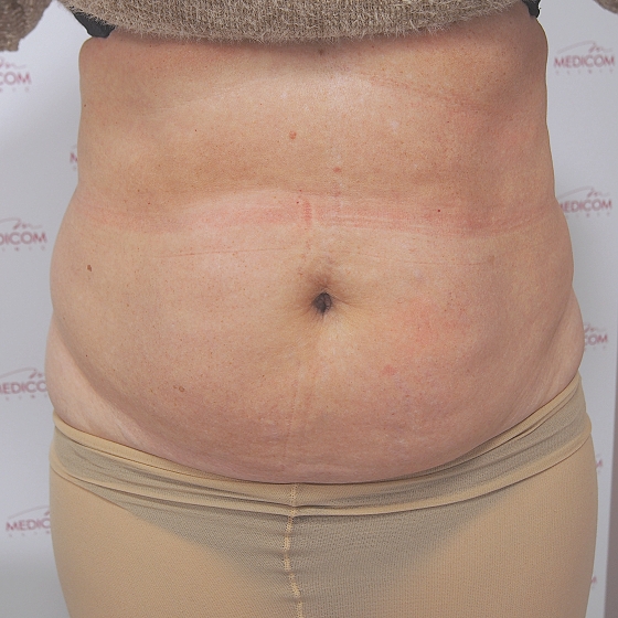 Klientka před a po neinvazivní liposukci (kryolipolýza) v oblasti břicha. 