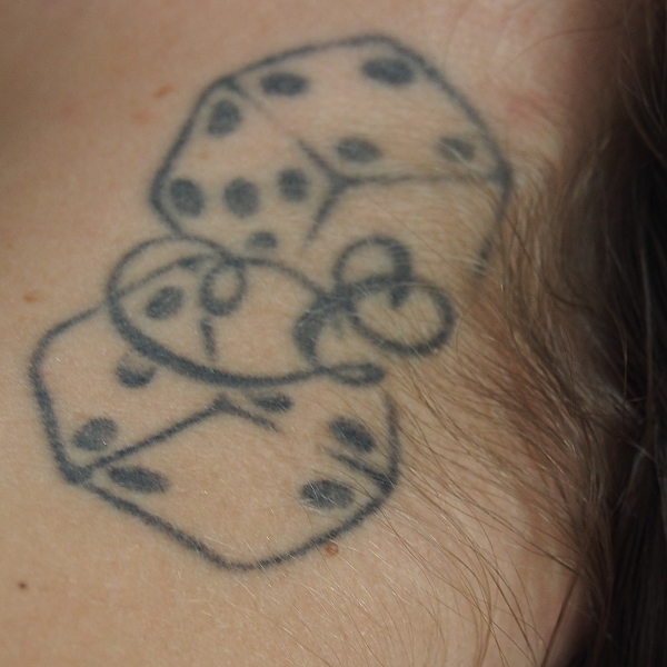 Klientka před a po odstranění tetování laserem (7 opakování)
Lékařka: MUDr. Jana Hlaváčková