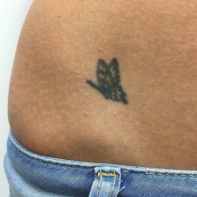 Klientka před a po odstranění tetování laserem (5 opakování)
Lékařka: MUDr. Katarína Třísková