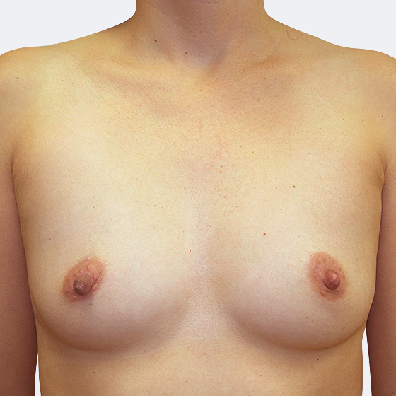 Klientka před a po zvětšení prsou. Použity byly kulaté implantáty o velikosti 375 a 400 mililitrů, vysoký profil. Vloženy byly podprsní rýhou pod sval.
Operatér: Prim. MUDr. Petr Pachman